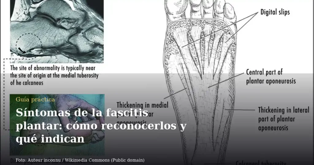Síntomas de la fascitis plantar: cómo reconocerlos y qué indican